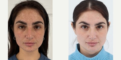 25-34 year old woman treated with Moxi, BroadBand Light (BBL) - 4 weeks after one session of Moxi & BBL.