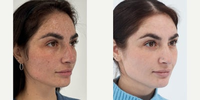 25-34 year old woman treated with Moxi, BroadBand Light (BBL) - 4 weeks after one session of Moxi & BBL.
