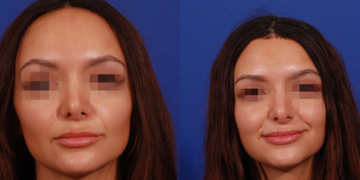 25-34 year old woman treated with Forehead Reduction - At the age of 28, this patient sought a solution for her perception of a larger forehead. Deciding on having Hairline Advancement in Tucson, she reached out to Dr. Jerold Olson at Foothills Facial Plastic Surgery. Motivated by a desire to reduce the height of her forehead and enhance her self-confidence, she understood that the radiance of her beauty would also enhance with a minor adjustment to her hairline. It's important to note that cosmetic procedures like hairline advancement, while not medically necessary, can have a profound impact on a patient's emotional wellbeing.