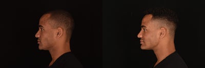 Man treated with Laser Treatment using Pixel Laser - Man treated with Laser Treatment using Pixel Laser