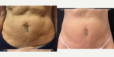 55-64 year old woman treated with SylfirmX Microneedling RF 3 treatments - This is a 64 year old woman with skin laxity in her abdominal area after liposuction. She was treated with 3 sessions of SylfirmX radiofrequecy microneedling.