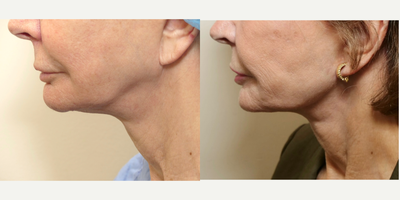 MyEllevate Plus for neck - 77 year old female who was complaining of the laxity of her neck and lack of jawline definition. She underwent the MyEllevate Plus procedure under local anesthesia which includes the placement of a permanent suture support system through tiny skin punctures under the border of the mandible to increase jawline definition, division of the muscle bands of the neck to enhance neck contour, and a skin tuck behind the ear to remove excess skin.