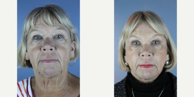 55-64 year old woman treated with ProFractional Laser, Laser Resurfacing - Sciton Laser Resurfacing