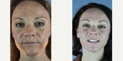 25-34 year old woman treated with Halo Laser - Sciton Halo Laser Resurfacing  combo BBL treatment