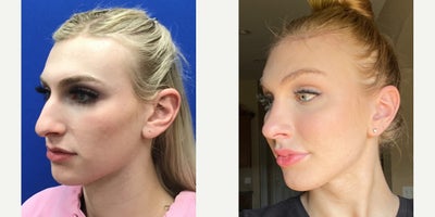 Adam's Apple Reduction, Forehead Reduction - Forehead Lift, Hairline Lowering, Orbital Bony Contouring Septorhinoplasty (closed) with Cartilage Grafts, Radix Graft and WeirsCheek Implants (small)Chin Reduction and ContourSubnasal Lip Lift with Fat Augmentation to LipsThyroid Cartilage ShaveMicrografts #510 to RecessionsFat Excision from Lower Lip