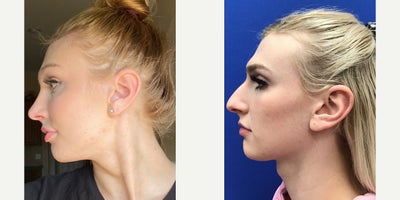 Adam's Apple Reduction, Forehead Reduction - Forehead Lift, Hairline Lowering, Orbital Bony Contouring Septorhinoplasty (closed) with Cartilage Grafts, Radix Graft and WeirsCheek Implants (small)Chin Reduction and ContourSubnasal Lip Lift with Fat Augmentation to LipsThyroid Cartilage ShaveMicrografts #510 to RecessionsFat Excision from Lower Lip