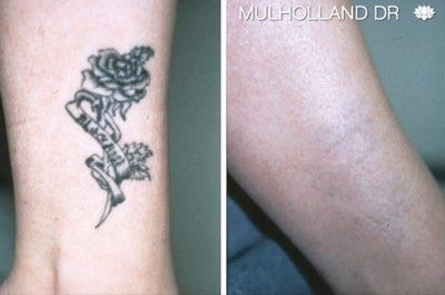 Picosure Laser Tattoo Removal - This patient had his tattoo removed using the PicoSure laser