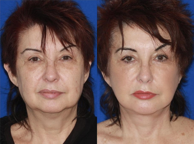Woman treated with Lower Face Lift - Advanced Facelift