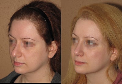 2 weeks after result of rhinoplasty/septoplasty - 
	Early 2 weeks after rhinoplasty result. Contrary to usual belief most patients good 2 weeks after nose job (not everybody as good but most are) results usually improve even more during next several months
