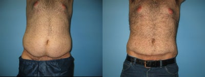 Male tummy tuck - 
	20 year old man before and after tummy tuck.
