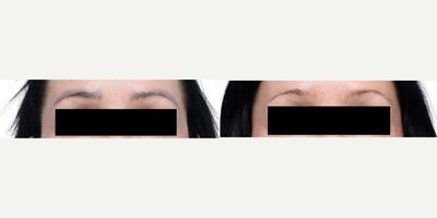 45 year old woman treated with Tattoo Removal - This 45-year-old patient sought removal of an unwanted eyebrow tattoo. Laser tattoo removal sessions were performed to gradually lighten and clear the pigment. The after images show significant fading and a more natural skin appearance.