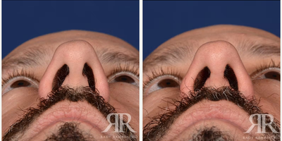 35-44 year old man treated with Rhinoplasty - Male Rhinoplasty