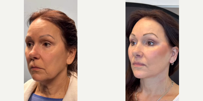 Woman treated with Buccal Fat Removal - Woman treated with Deep Plane Facelift, Neck Lift, Buccal Fat Removal, Facial Fat Transfer, and Lip Lift.