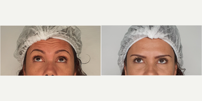 35-44 year old woman treated with Botox - B&A botox treatment for glabellar lines