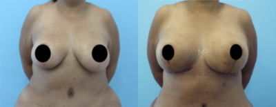 35-44 year old woman treated with Breast Implant Removal - Happy patient after her SALINE implants removal + breast lift