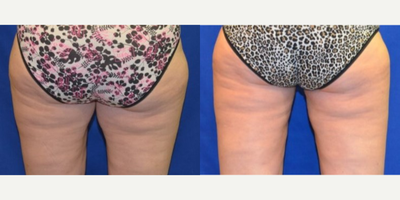 45-54 year old woman treated with Smart Lipo - Woman came in wanting to improve the look of her thigh area. After consulting with Dr. Ho, patient elected to have liposuction performed to inner and outer thighs.