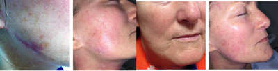 55-64 year old woman treated with CO2 Laser - co2 laser of scar from Lifesyle lift