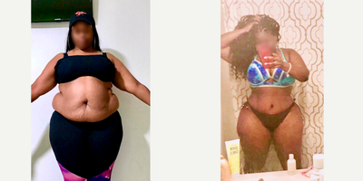 Tummy Tuck Results - Outcome after Full Tummy Tuck combined with Intense Liposuction including abdomen, waist, laterals and upper and lower back to improve your body contour and get better curves, especially in your waist area and Dominican Butt Lift.