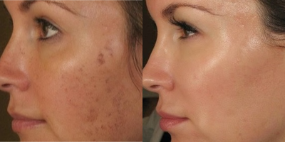 25-34 year old woman treated with Bella Skinpen microneedling - Bella Skinpen microneedling for acne scarring after 5th treatment