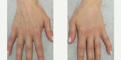 45-54 year old woman treated with Hand Rejuvenation, Radiesse, Juvederm - Hand rejuvenation with dermal filler injection (Radiesse, Juvederm) using micro-cannula technique
