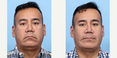55-64 year old man treated with Chin Implant, Facial Fat Transfer - Two months after undergoing a chin implant and facial fat transfer with Dr. Wise, this patients profile is beautifully enhanced, with restored volume and a more balanced appearance.