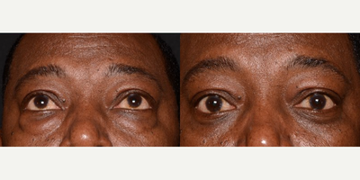 Woman treated with Eyelid Surgery - Treatment: Lower EyesPurpose: To reduce lower eyelids wrinkles, skin redundancy, and fat bulgesTreatment Time: 2 Hours