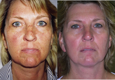 Patient treated with IPL to reduce sun damage - Pre and Post IPL treatment for a patient with sun damage on the face.