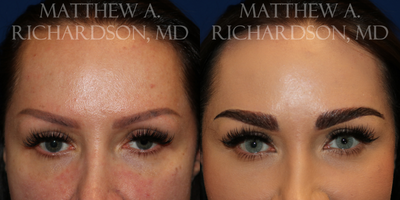 35-44 year old woman treated with Eyebrow Transplant - Female patient treated with Eyebrow Transplant: 175 grafts on each brow (350 grafts total). 5 months post-op.
