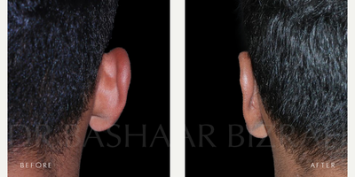 18-24 year old man treated with Ear Surgery, Earfold - 18-24 year old man undergoes Otoplasty with Dr Bashar Bizrah