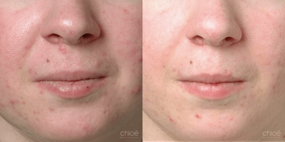 Dilated Pores Treatment using Chemical Peel - Skin pores allow the skin to breathe and to evacuate impurities. They can sometimes become clogged and dilated, giving the skin an irregular appearance. This condition can be effectively treated with chemical peels.