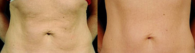 45-54 year old woman treated with Thermage - 3 months after Thermage abdomen