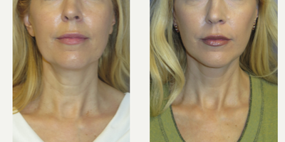 52 year old woman treated with Lower Face Lift - 52 year old female with a droopy jowls and neck. She wants to look more refreshed. She had a FACEology LIFT (lower face and neck lift) under local anesthesia and oral sedation. Note, the natural results along the jaw and neck line.