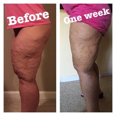 🥇 Dallas TX Lipedema Treatment  Plano Lipedema Leg Fat Removal