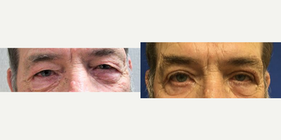 55-64 year old man treated with Eyelid Surgery - Patient had Blepharoplasty performed