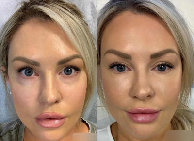Woman treated with Injectable Fillers - Woman treated with Injectable Fillers