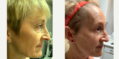 45-54 year old woman treated with Neo Laser, YAG Laser - Aerolase Neo Laser for skin rejuvenation