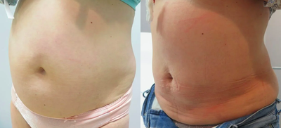 45-54 year old woman treated with TickleLipo and SmartLipo Liposuction - Before and after a combination of Tickle Lipo and Smartlipo