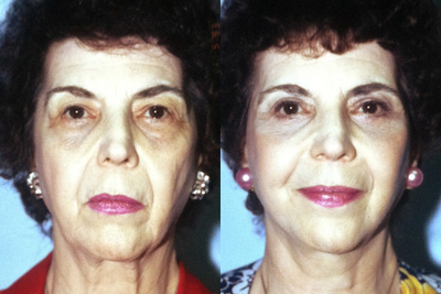 This 67-year-old Woman had a Face Lift and a Blepharoplasty - This 67-year-old Woman had a Face Lift and a Blepharoplasty