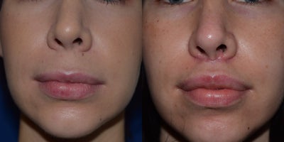 25-34 year old woman treated with Lip Lift - Lip lifts can be done in one of two methods. In the upper lip, a bullhorn incision under the nose can be used, exposing more of the pink surface. Another procedure for the upper lip is what is known as a vermillion advancement where the skin above the upper lip is removed and more of the pink tissue is exposed. This incision achieves another goal, which is to remove the deep lines that form above the lip.