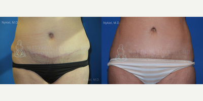 Woman treated with Tummy Tuck Revision - Woman treated with Tummy Tuck Revision