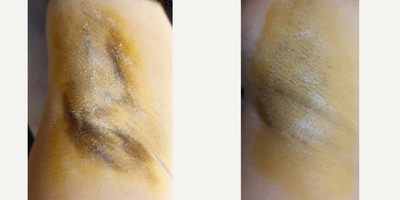 25-34 year old woman treated with miraDry - Patient Iodine starch test shown before miraDry treatment and 2 weeks after 1 treatment for permanent underarm sweat and odor reduction. 
An iodine solution is applied to the skin and allowed to air-dry. Once dry the area is dusted with cornstarch or potato flour. When sweat reaches the surface of the skin the starch and iodine combine causing a dramatic color change (yellow -&gt; dark blue) allowing sweat production to be actively visualized.