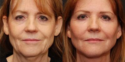 Woman treated with Fat Transfer - Fat Transfer