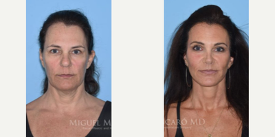 Woman treated with Facelift - Woman treated with Facelift, Brow Lift, Eyelid Surgery through upper blepharoplasty, and Lip Lift with corner lift. Then a year later Facial Fat Transfer and Rhinoplasty. Patient is shown before and 3 years post-op.
