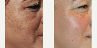 Melasma Treatment Los Angeles - This Hispanic patient had severe Melasma and had tried everything she could get her hands on. Our formulation works better than anything we've found because it is 8% hydroquinone and delivered in a gel solution that penetrates deeply into the skin to treat Melasma at it's source.