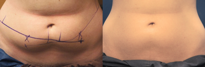 A Female Patient Who Underwent Coolsculpting - 
	Patient who underwent Coolsculpting.
