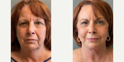 Woman treated with Facelift - Woman treated with Deep Plane Mini Facelift, Eyelid Surgery through upper and lower blepharoplasty, Brow Lift with Renuvion, and Facial Fat Transfer through lipocube.