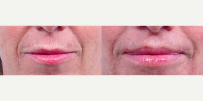 45-54 year old woman treated with Lip Lift, Lip Surgery - Beautiful patient before and after lip lift surgical procedure.