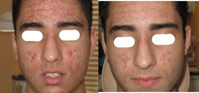 18-24 year old man treated for Acne Treatment - This patient was treated with a Dermapen.&nbsp;