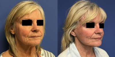65-74 year old woman treated with Facelift - 72 year old female who wanted a more youthful appearance so she looks as good as she feels. She had a Monarch Mini Facelift with neck liposuction and a platysmaplasty.