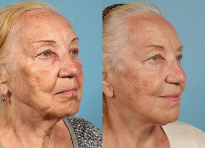 Patient treated with Facelift - Patient treated with Facelift